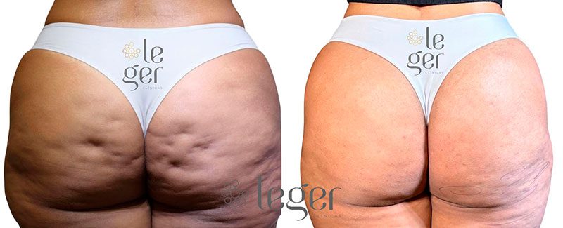antes-e-depois-goldincision-2-celulite-leger.jpg