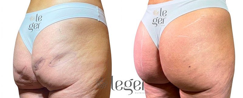 antes-e-depois-goldincision-3-celulite-leger.jpg