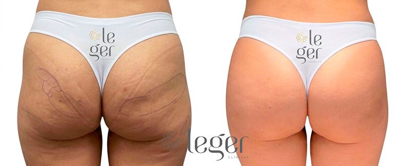 antes-e-depois-goldincision-celulite-4-leger.jpg