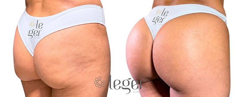 antes-e-depois-harmonizacao-glutea-2-leger.jpg