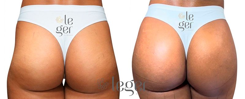 antes-e-depois-harmonizacao-glutea-3-leger.jpg