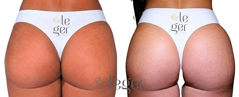 antes-e-depois-harmonizacao-glutea-leger.jpg